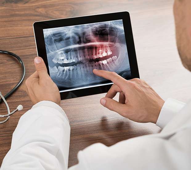 St. Louis Types of Dental Root Fractures
